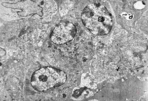 celiakia - plasmocytes in propria celiakia - plasmocytes in propria